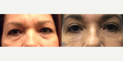 Woman treated with Eyelid Surgery, Botox - Upper + Lower Blepharoplasty Follow-up & Botox!Dr. Wolf is a firm believer in how doing your eyes is an amazing procedure to look more refreshed! He also shows how a Blepharoplasty scar is meant to be almost unnoticeable & how its not meant to change the shape of your eye if done correctly!