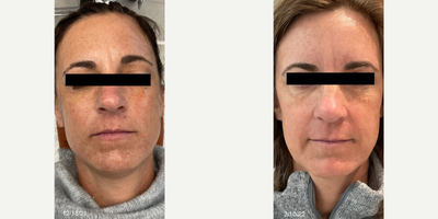45-54 year old woman treated with Potenza - Potenza RF microneedling with PRP. No downtime, slightly red for a few hours after treatment. Minimal discomfort during procedure, no pain after procedure. Numbing cream is optional. Procedure time 30-40 min.