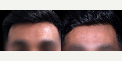 Man treated with Clear and Brilliant - Man treated with Clear and Brilliant