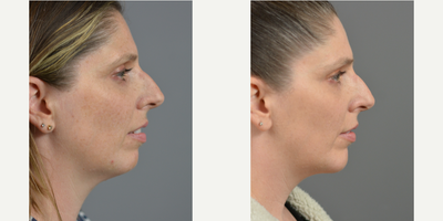 35-44 year old woman treated with Chin Implant - This patient had a goal of making her profile more symmetrical. Dr. Marotta achieved this result with a chin implant and liposuction of the neck.