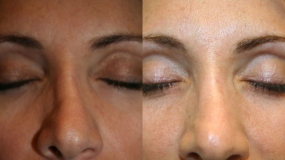 Non-Surgical Nose Job  - Crooked nose treated with Juvederm Dermal Filler. Non-surgical nose job.