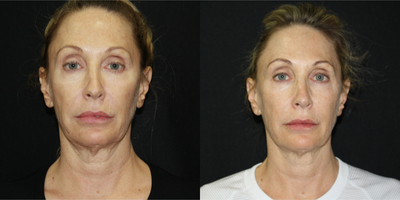 55-64 year old woman treated with Infini RF - 55-64 year old woman treated with Infini RF