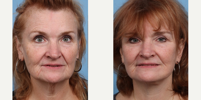 55-64 year old woman treated with Facelift - 3 months post Facelift