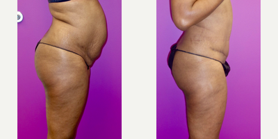 35-44 year old woman treated with Tummy Tuck - 6 months following Tummy Tuck with liposuction.