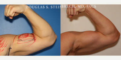 Man treated with Bicep Implants - Man treated with Bicep Implants
