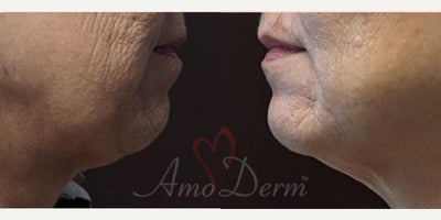 55-64 year old woman treated with Juvederm, Liquid Facelift, Restylane, Volbella, Voluma - liquid facelift with filler injection in cheeks, nasolabial folds & marionette lines with Juvederm, Restylane, Voluma, BellaFill, Radiesse, Vollure