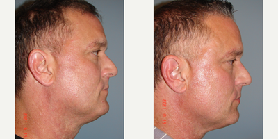 45-54 year old man treated with Skin Tightening - Patient not interested in surgical facelift. 6 non-invasive treatments of Evoke performed on lower face and neck.