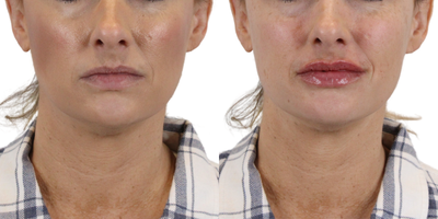 35-44 year old woman treated with 1 syringe of Lip Filler - Our wonderful patient came in wanting fuller, more defined lips. One of our AdmireMD Injectors strategically filled one syringe of HA Filler to create symmetrically plumped lips! 