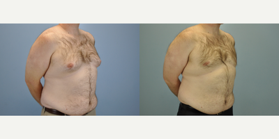 25-34 year old man treated with Gynecomastia Surgery - This patient who measures 5'10 and 240 lbs underwent subcutaneous mastectomy with Vaser liposelection to treat his gynecomastia condition. Seen here are his results at 4 months post-op.