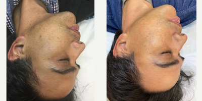 35-44 year old man treated with eMatrix - eMatrix laser skin resurfacing is an FDA-cleared treatment that gently resurfaces the skin over 4 to 5 treatments. It tightens surface loose skin, improves skin texture and reduces the appearance of mild to moderate wrinkles, acne scarring and abdominal stretch marks.
