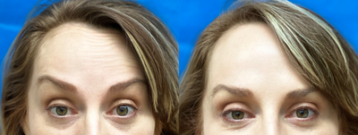 35-44 year old woman treated with Botox for Migraines - Beautiful patient treated for chronic headaches and forehead wrinkles.