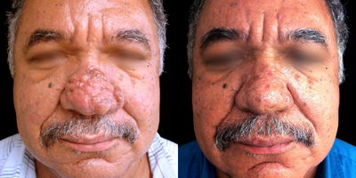 55 year old male treated with DeepFX, Dermabrasion - This patient underwent dermabrasion and DeepFX laser resurfacing to address rhinophyma