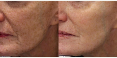 55-64 year old woman treated with Age Spots Treatment - Age spots, sun damage, and freckles drastically reduced with the LaseMD! We recommend monthly treatments, depending on your skin's condition and what you'd like to achieve. Beautiful results, every time!