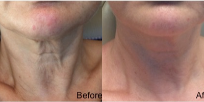 55-64 year old woman treated with Fractional Laser - Patient had two Sublative Fractional RF treatments for skin tightening (radio frequency) and texture (fraxel) along with Kybella (stubborn fat under chin.)