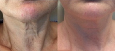 55-64 year old woman treated with Kybella - Patient was treated with Kybella under chin (and two Sublative fractional RF treatments on neck and face.)