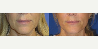 Woman treated with Facelift - Woman treated with Facelift