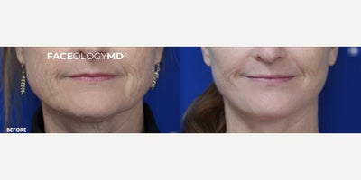Woman treated with Facelift - Woman treated with Facelift