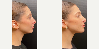 Woman treated with Chin Filler, Renuva - A subtle yet impactful transformation of our beautiful patient a little chin filler and some renuva in her pre-auricular for that lifting effect