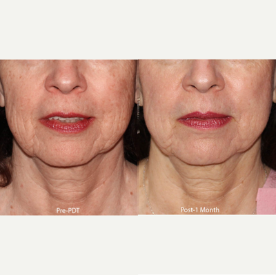55-64 year old woman treated with Photodynamic Therapy - The doctorused PDT to treat this patient's sun damage to treat her fine lines and wrinkles.