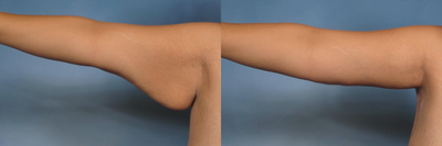 Arm Lift  - 
	I utilized the posterior/inferior incision to help hide the scar from the arm lift in the patient as well as to address the massive excess of skin in the&nbsp;bottom portion of her upper arm.&nbsp; The patient is shown 4 months after her arm lift.
