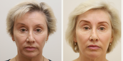 55-64 year old woman treated with TCA Peel, Facial Fat Transfer - Fat grafting and TCA peel to face