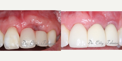Revised surgery, missing two front teeth - Female patient with two missing front teeth and previous unsuccessful surgeries by another surgeon.  Bone grafting and gum grafting surgeries were performed to augment the site before placing two dental implants.