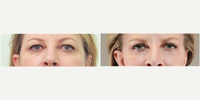 Woman treated with Lower Facelift, Neck Lift, Brow Lift - Woman treated with Lower Facelift, Neck Lift, Brow Lift