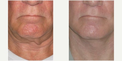 Man treated with Neck Lift - Man treated with Neck Lift