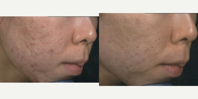 25-34 year old woman treated with EndyMed 3Deep - 25-34 year old woman with darker skin type treated with EndyMed 3Deep for acne scars before and 6 months after.