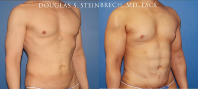 Man treated with Bicep Implants - Man treated with Bicep Implants