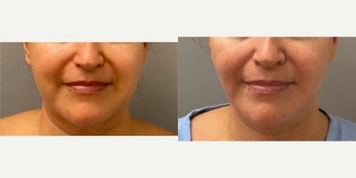 45-54 year old woman treated with Buccal Fat Removal - 54 yo s/p Naturalyft SMAS plication facelift with buccal fat removal performed under local anesthesia with sedation in our on site AAAA certified operating suite.