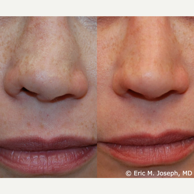 Non-Surgical Rhinoplasty Before & After: Nostril Asymmetry Correction - This is an excellent demonstration of permanent non-surgical nostril lowering in our patient who had ten rhinoplasties performed elsewhere. Two years ago, she came to us for her concerns about her nostril asymmetry, and you can see permanent correction now, two years after her treatment. We performed a third treatment today to lower her right nostril margin another 2 millimeters for symmetry. After so many nasal surgeries, temporary gel fillers may be more likely to cause problems like skin necrosis or blindness. Since the size of a Silikon-1000 molecule is smaller than a red blood cell, there are no reported cases of necrosis, infection, biofilm, or blindness with the serial-puncture microdroplet technique.