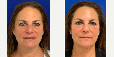 55-64 year old woman treated with Laser Resurfacing - My 62 year old patient after 2 sessions of CO2 laser. She had her treatments 5 weeks apart. As you can see, the laser has tightened her skin (especially around her eyes!), reduced redness and improved her overall tone and texture.