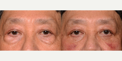 65-74 year old man treated with Eyelid Surgery - Age: Over 60. Patient wanted to improve the lower eyelid area. After his consult he elected to have surgery to rejuvenate the look of the area.