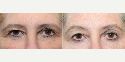 Woman treated with ThermiSmooth - Woman treated with ThermiSmooth