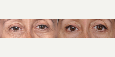 Woman treated with ThermiSmooth - Woman treated with ThermiSmooth