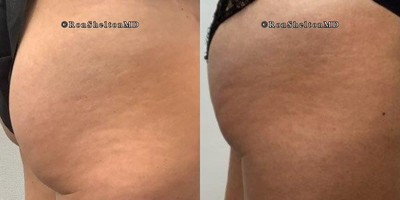45-54 year old woman treated with CoolTone - 48 year old woman treated with CoolTone to firm and raise the bottom of the buttocks with a series of Cooltone treatments