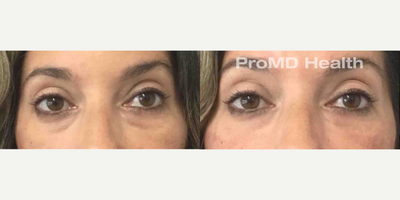 Woman treated with Sculptra, Hyaluronidase - Woman treated with Sculptra, Hyaluronidase