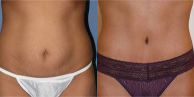 25-34 year old woman treated with Tummy Tuck - mini tummy tuck