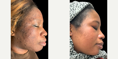 25-34 year old woman treated with Chemical Peel, Glycolic Peel, Jessner Peel, Microneedling, SkinPen - Female, Fitzpatrick 5Treating: Acne, Acne Scaring, Hyperpigmentation, TextureTreatment: 4 Microneedle + Topical PRP Treatments, 2 Transformation Peels + Extractions