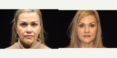 55-64 year old woman treated with Liquid Facelift - This 58 year woman was heavily scarred from multiple radiation treatments post tonsil cancer. She wanted a treatment that would not only help with her scarring but improve her overall appearance. She had 2 syringes of Juvederm to her oral commissure, chin, and pre jowl sulcus. She also had botox to her corrugator, crowss feet, and forehead.