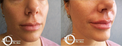 25-34 year old woman treated with Juvederm - Lip Augmentation , Juvederm