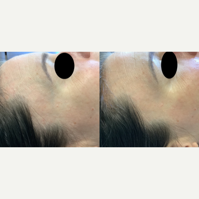Female Patient Treated with Asclero/Sclerotherapy for Facial Veins - Before & After 2 sessions of Sclerotherapy for facial veins
