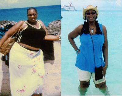 Before at 310 lbs - Patient underwent Vertical Sleeve gastrectomy with a starting weight of 310 lb, since her surgery, She has lost a total of 103 lbs in 1.5 year