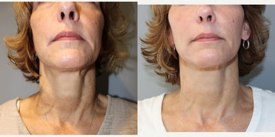 55-64 year old woman treated with Vampire Facial - vampire neck56 yo, F, 59, 138lbs, G3P3
