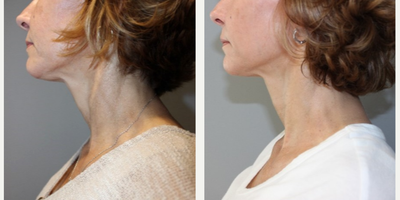 55-64 year old woman treated with Vampire Facial - vampire neck56 yo, F, 59, 138lbs, G3P3
