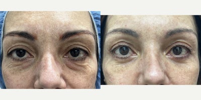 45-54 year old woman treated with Eyelid Surgery - Upper and lower eyelid surgery under sedation in our office operating room.