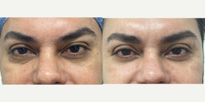 45-54 year old man treated with Eyelid Surgery - Lower eyelid surgery under sedation in our office operating room.