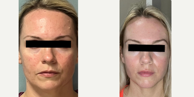 35-44 year old woman treated with Opus Plasma - This client struggles with Rosacea. She also wanted to target any visible signs of aging. The results shown are after completing 2 Opus treatments 4 weeks apart each.