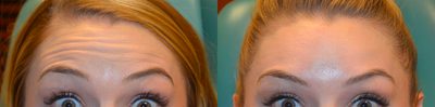 18-24 year old woman treated with Dysport - Before and after neuromodulation for dynamic (movement wrinkles).  Improved results in active wrinkling without an unnatural appearance is seen.